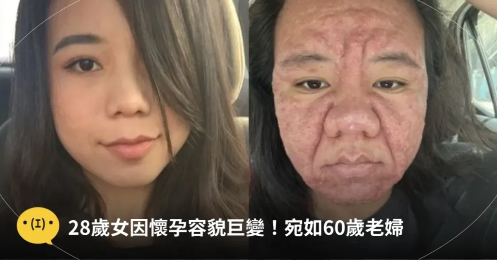 因懷孕容貌大變！28歲準媽媽崩潰「變成60歲阿嬤」，公開「原本清秀模樣」崩潰：為什麼是我…